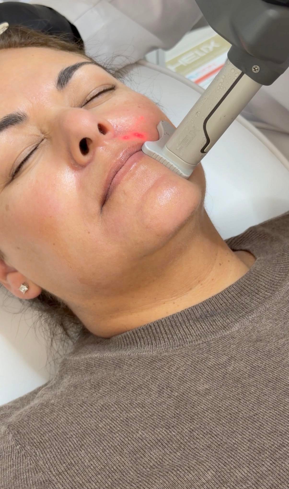 Best CO2 Facials Treatment