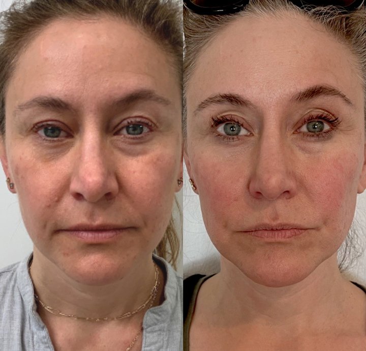Microneedling with Serums Treatment