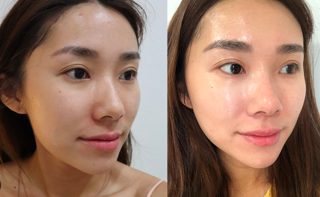 Skin Rejuvenation Treatment