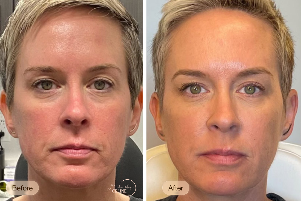Sculptra before and after