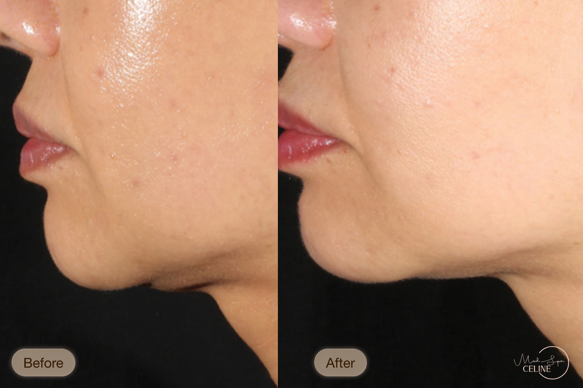 XERF before and after