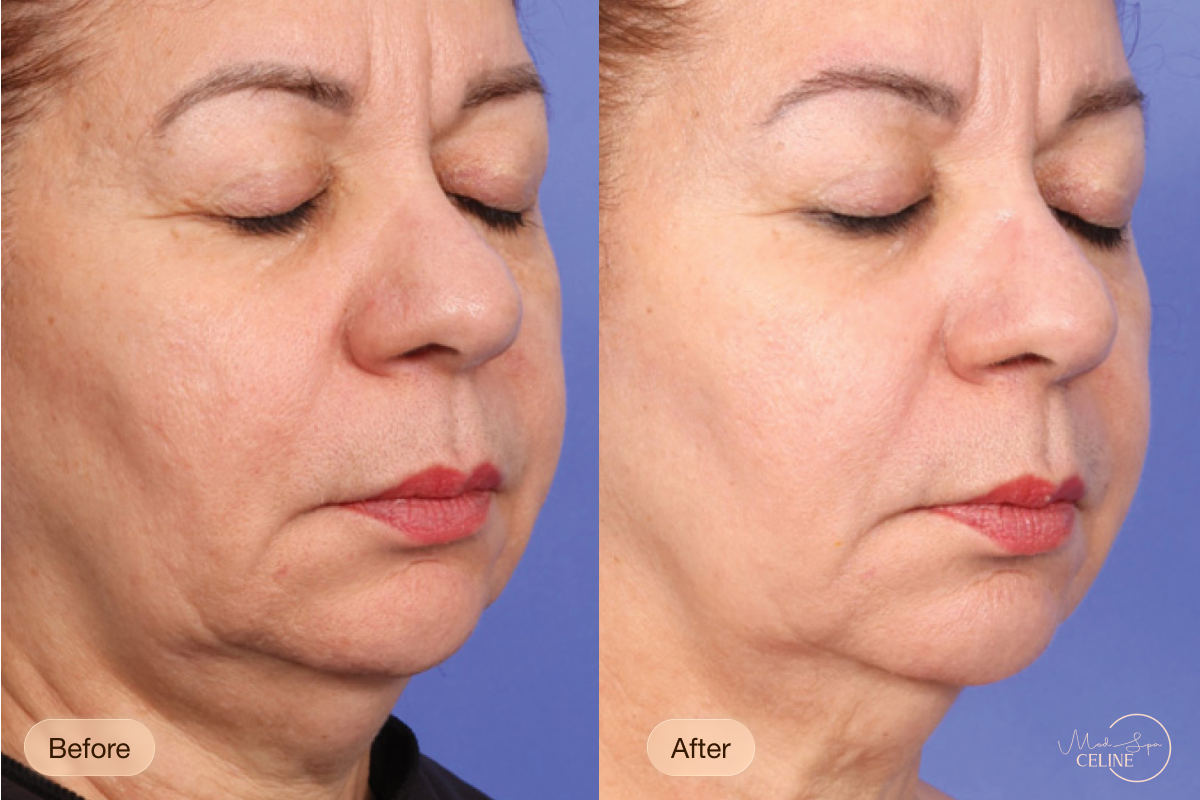 XERF before and after