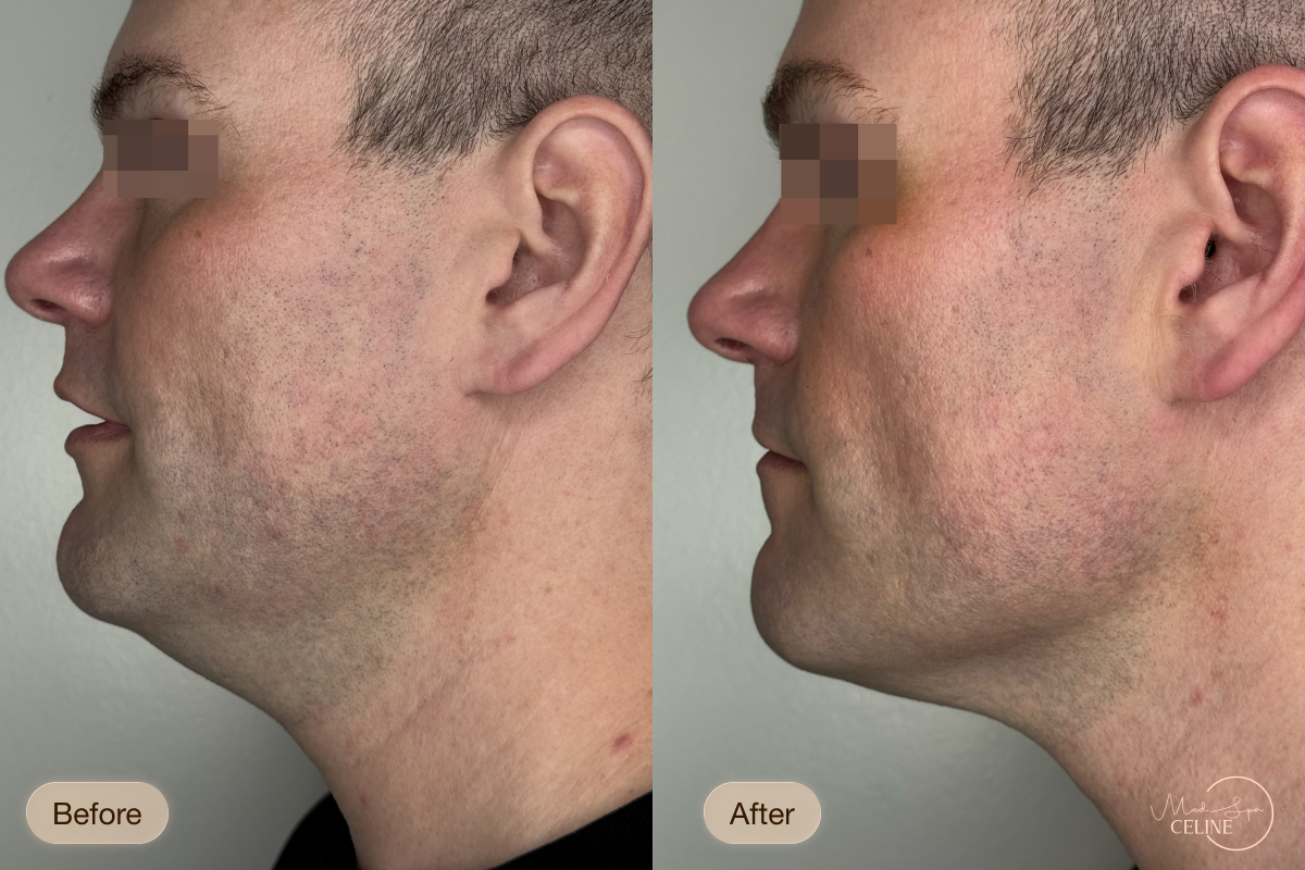XERF before and after