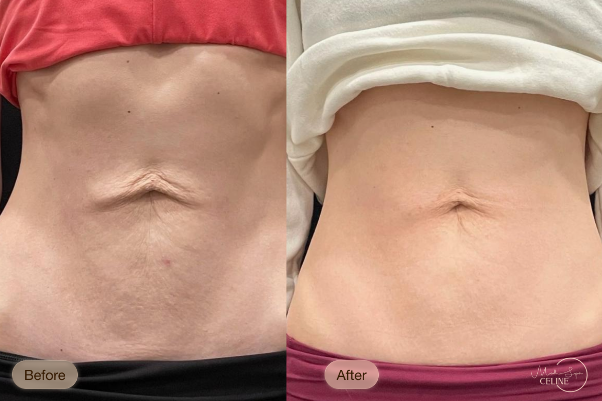 XERF before and after