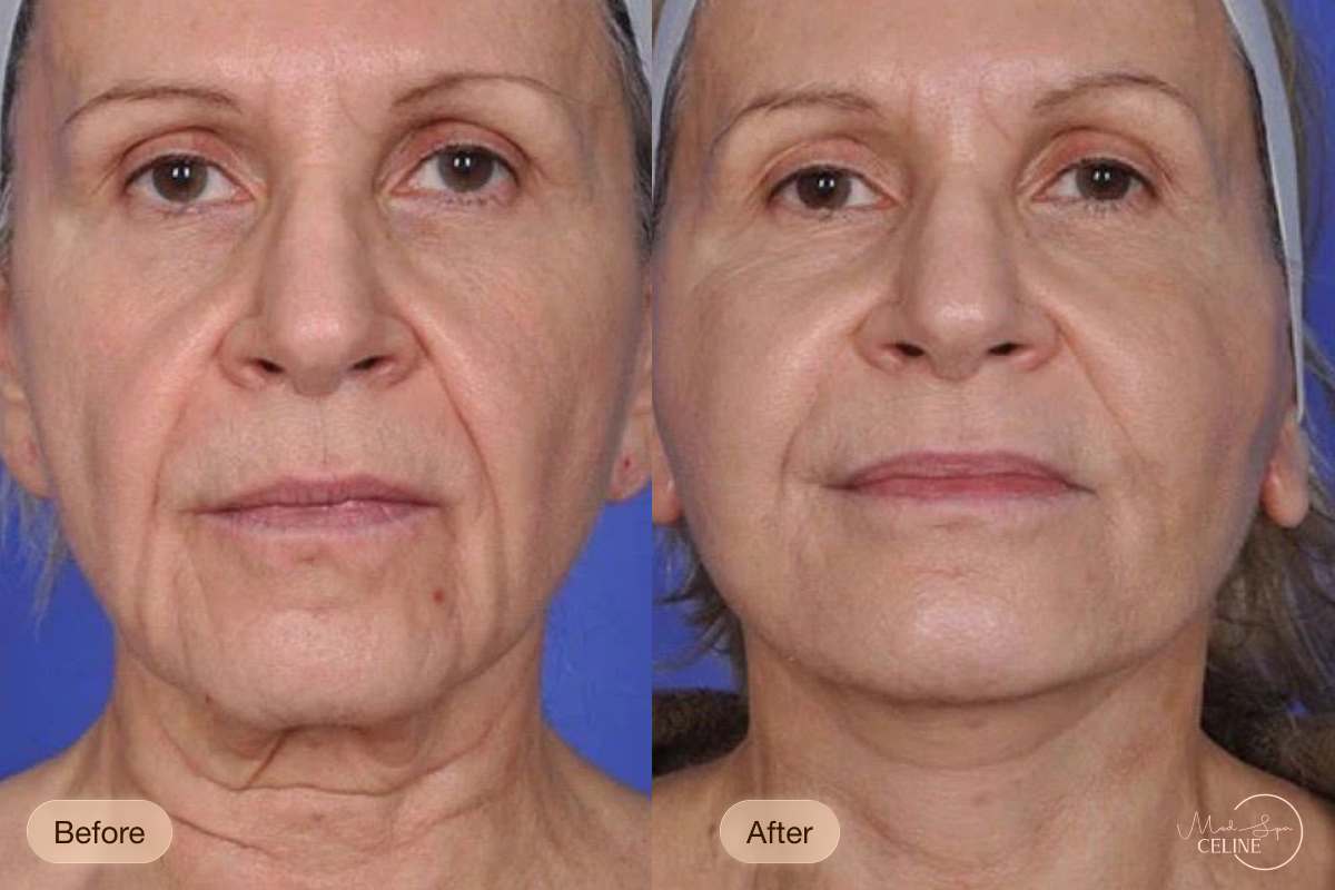 XERF before and after