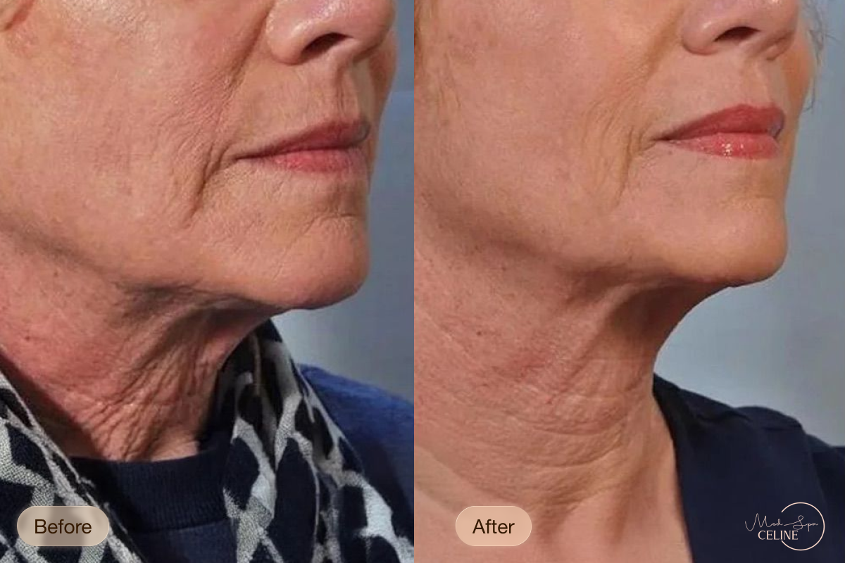 XERF before and after