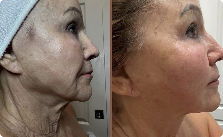 XERF before and after